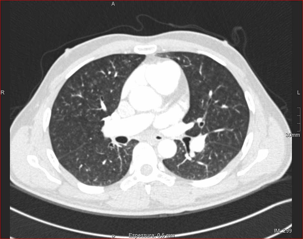 HipertensãoPulmonar persistente do RN 1*. Doença Pulmonar Veno-oclusiva e Hemangiomatose Capilar Pulmonar 2. Hipertensão Pulmonar por Cardiopatia Esquerda 3.