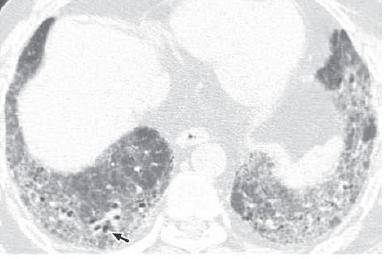 Doença Pulmonar Veno-oclusiva e Hemangiomatose Capilar Pulmonar 2. Hipertensão Pulmonar por Cardiopatia Esquerda 3. Hipertensão Pulmonar por Doença Pulmonar ou Hipóxia 4.