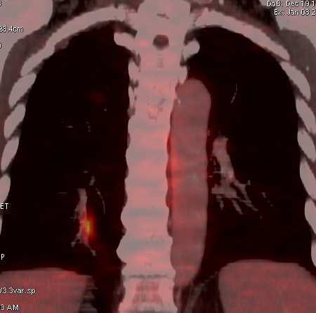 Carcinoma de cels renais,