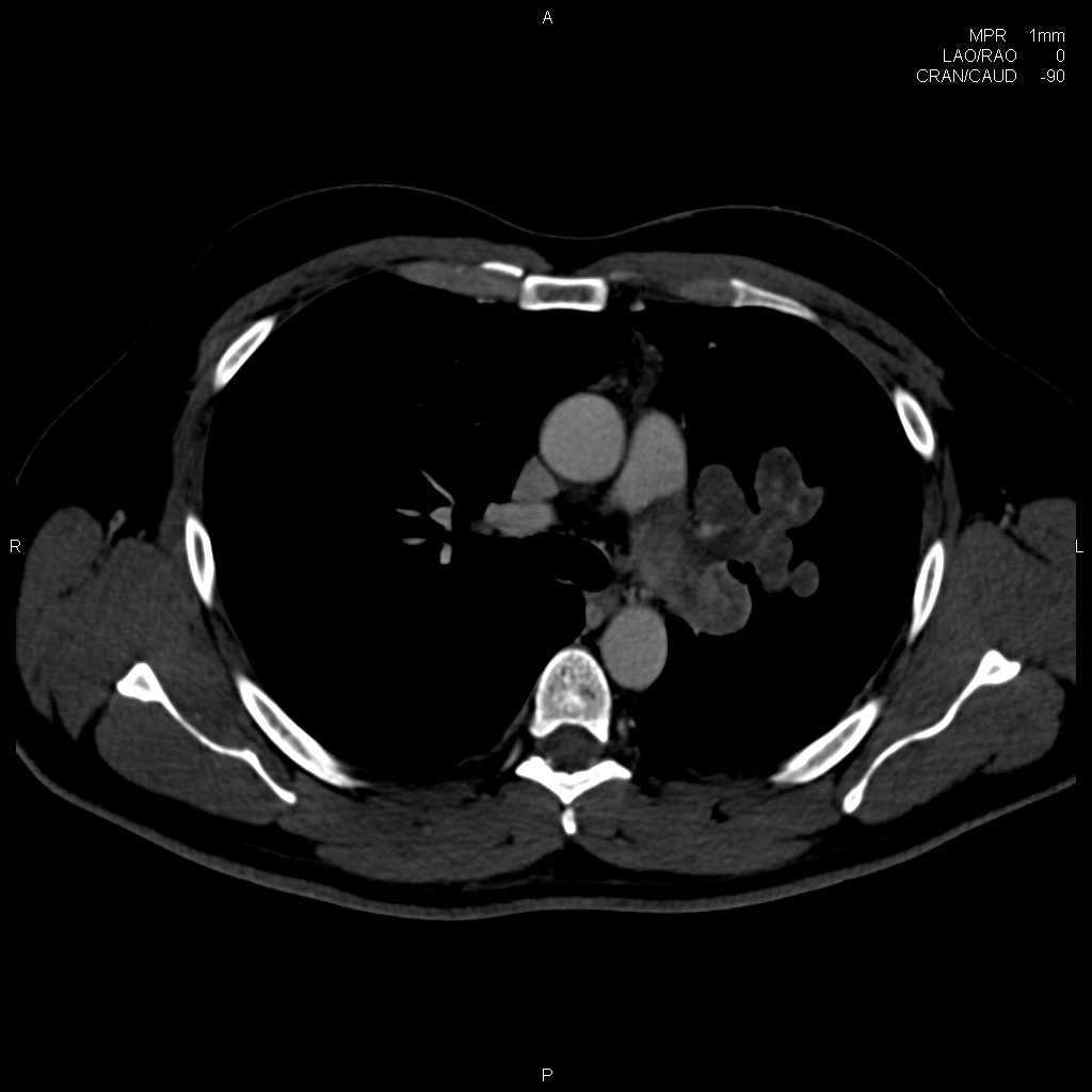 intra-abdominais 52a, masculino, Ca