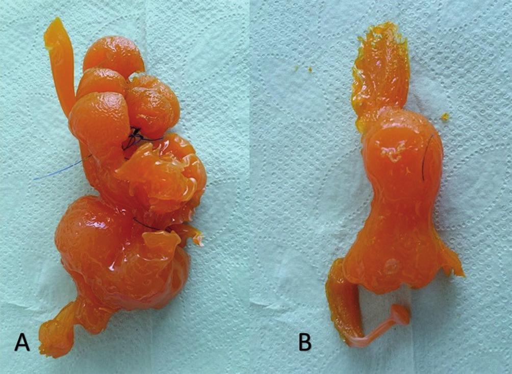 após a modificação anatômica, com enchimento do estômago em alta pressão (50 mmhg) de água FIGURA 6 - Modelo plastificado com cianoacrilato mostrando diferenças na