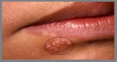 Herpes Simples Lesões de membranas mucosas e pele, ao redor da cavidade oral (herpes orolabial vírus