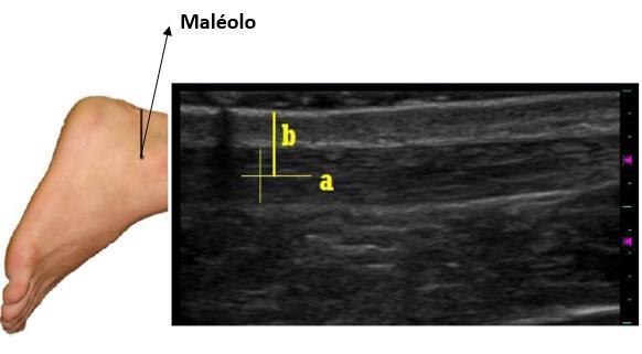 25 2.5 BRAÇO DE ALAVANCA A obtenção correta e confiável do braço de alavanca do tendão de Aquiles é essencial para uma modelagem analítica do comportamento mecânico atuante no membro (FATH et al.
