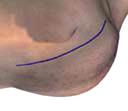 Acesso cirúrgico Veia cefálica Peitoral grande Bíceps braquial Deltóide O paciente é colocado na posição