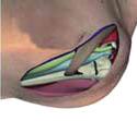 Afaste a veia cefálica lateralmente e peitoral medialmente Redução da fratura Reduza a fratura através de