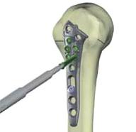 da superfície articular C) Polyaxial locking screw Use a poliaxialidade e bloqueie os 2 primeiros parafusos proximais e o