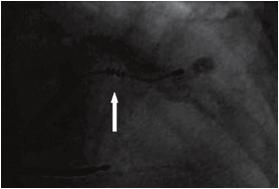 MÉTODOS - 23 unipolar foi introduzido em uma das veias das paredes anterolateral, lateral ou póstero-lateral (Figura 2).