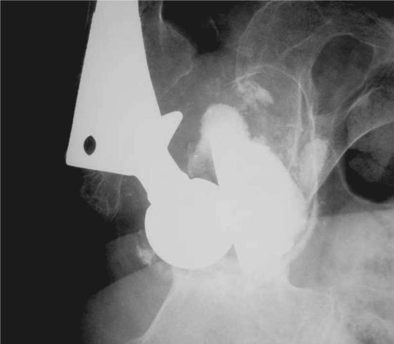 232 Acompanhamento a médio prazo da reconstrução acetabular com enxerto ósseo liofilizado bovino e dispositivo de reforço Figura 2 Radiografia anteroposterior do afrouxamento acetabular, deficiência