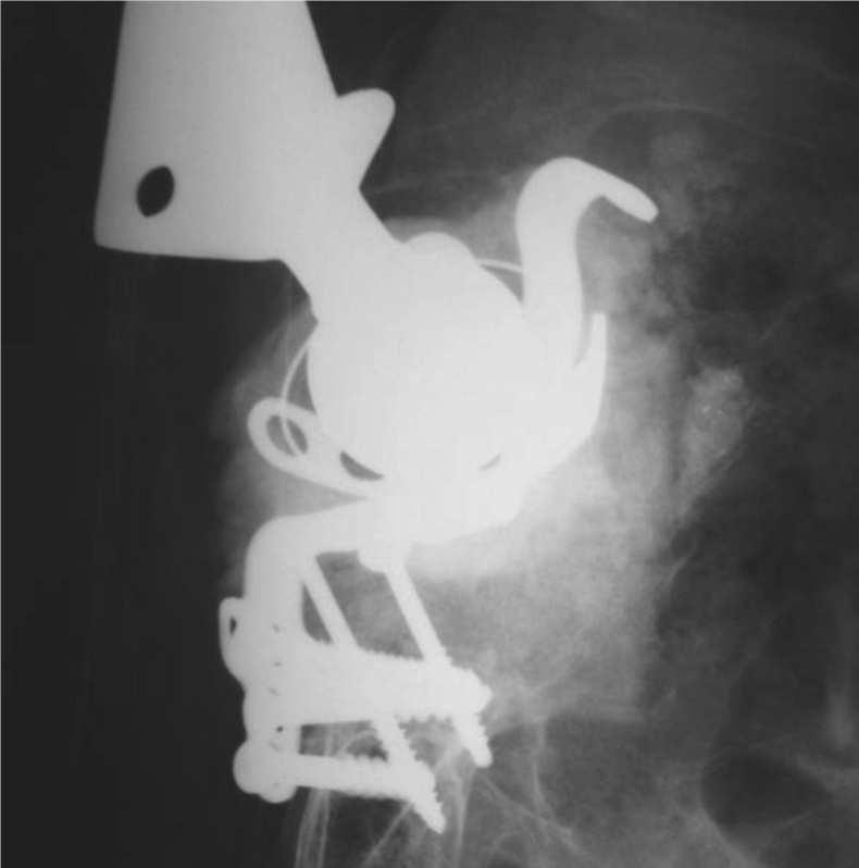 1 Figura 4 Radiografia anteroposterior da reconstrução com enxerto bovino liofilizado e dispositivo de reforço (acompanhamento de 3 anos), mostrando sinais sugestivos de incorporação óssea, conforme