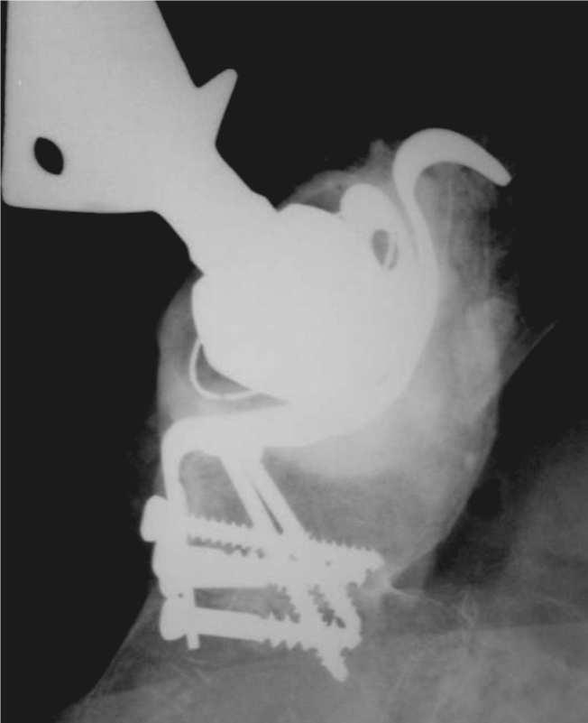 Figura 3 Radiografia no pós-operatório imediato mostrando a reconstrução acetabular com enxerto bovino liofilizado e dispositivo de reforço.