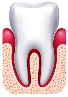 Doença periodontal A gengivite e a periodontite são doenças infecciosas que têm como principal causa a placa bacteriana, mas são resultados de diferentes respostas dadas