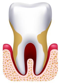 A principal diferença entre as duas é que a gengivite é uma inflamação localizada nas regiões marginais da gengiva. Normalmente elas se encontram na parte visível do dente.