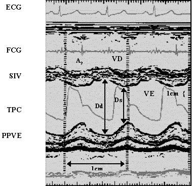 Figura 2. Incidências padronizadas para aquisição de imagem na ecocardiografia bidimensional (Schiller NB, et al. Circulation 1979;60:547).