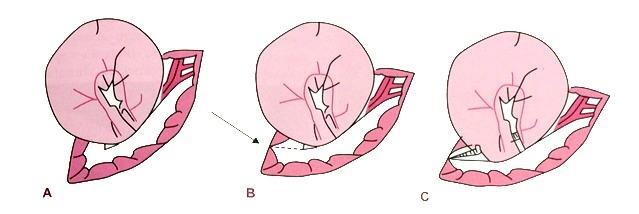 45 aumento da pressão intra - abdominal devido ao acúmulo de gordura (SILVA, et al., 2014). Figura38 Ampliação do defeito hernário Fonte: FERANTI; BRUN, 2017.