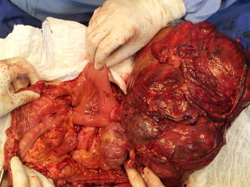 implante neoplásico em omento. Margens cirúrgicas maior e menor do segmento intestinal livres de neoplasia e linfonodos adjacentes ao omento livres de comprometimento neoplásico.