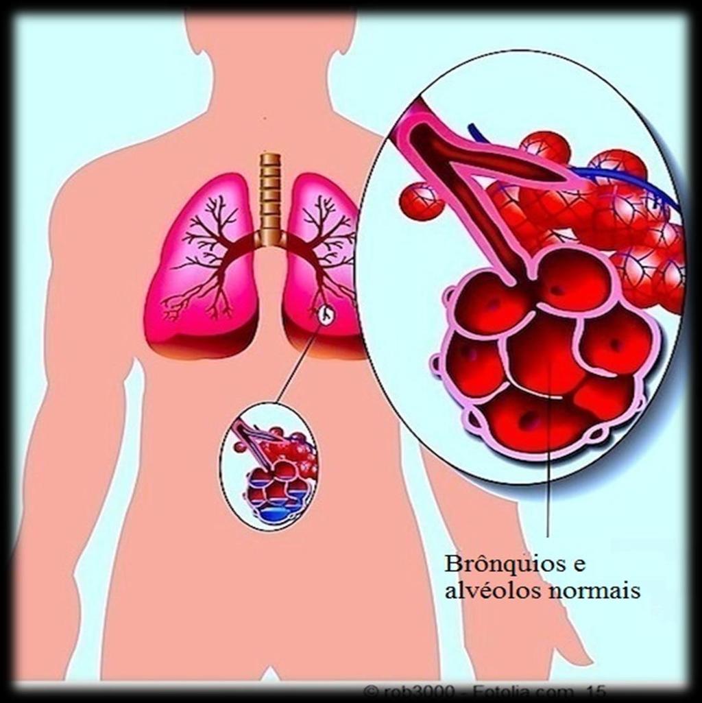 Mas o que é pneumonia?