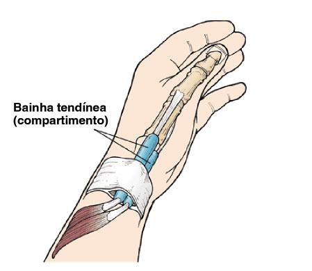 Algumas doenças sistêmicas também causam tenossinovite no punho, como artrite reumatóide, gota e diabetes. Quais são os sintomas?