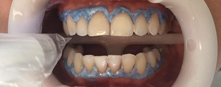 Após a aferição inicial da cor o tecido gengival dos dentes a serem clareados foi isolado usando uma barreira de resina fotopolimerizável (Top Dam, FGM, Produtos Odolontológicos, Joinville, SC,
