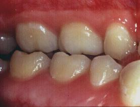 Material e métodos 44 Figura 5: contato único no JIG para impedir qualquer contato dentário. Figura 6: contato interferente distante aproximadamente 1mm do seu antagonista.