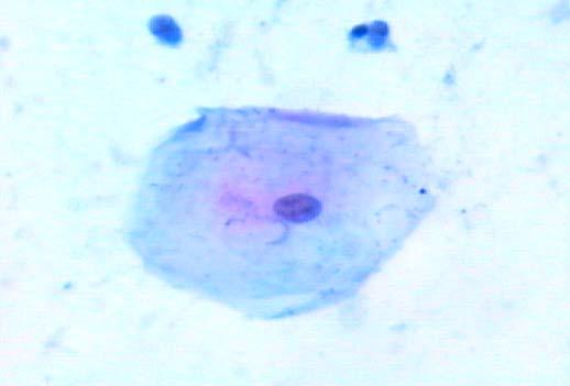 nucleadas (Classe I). Coloração de Papanicolaou Modificado. (400x) Figura 4.