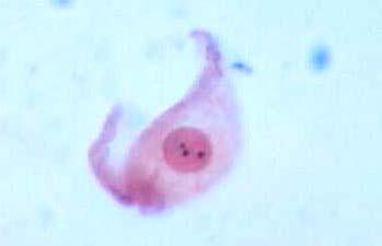 Figura 5. Fotomicrografia de célula atípica impregnada pela prata observada em esfregaço de soalho bucal de paciente fumante.