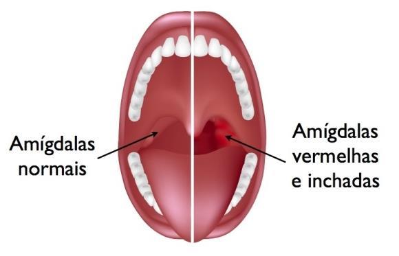 Inflamação das amígdalas provocada