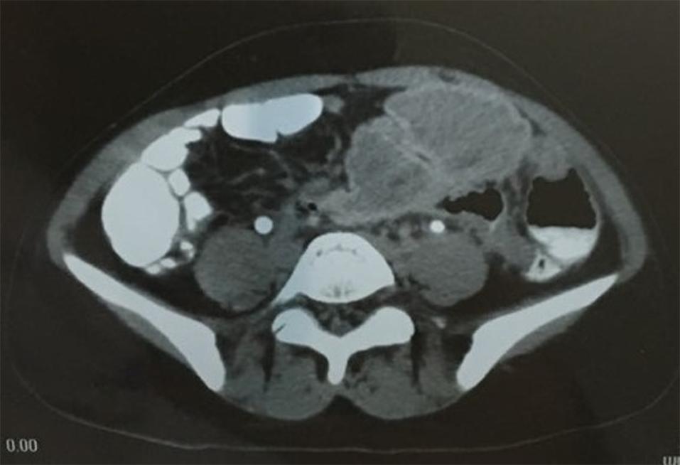 TC de abdome com lesão tumoral a esclarcer e marcador metálico em seu interior (gossipiboma) J.V.S.