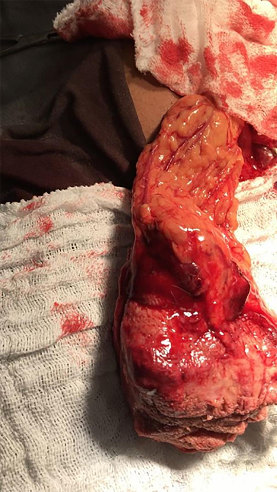 4 Figura 6. Abdome com dreno em flanco esquerdo e eliminação de secreção entérica por ferida operatória de laparotomia e orifício fistuloso em fossa ilíaca direita Figura 5.