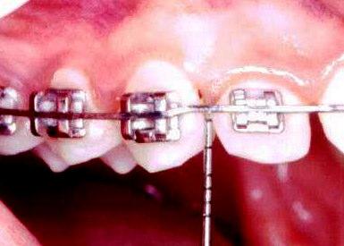 71 A profundidade de sondagem é a distância da margem gengival até o fundo do sulco gengival ou até a bolsa periodontal (nos casos de doenças periodontal instalada).