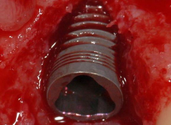 3 Adicionalmente, os implantes com a superfície TiUnite aumentam as taxas de sobrevida quando usados em cirurgias de revisão.