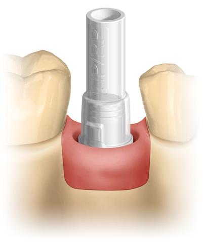 10133487 Fluxo de trabalho totalmente versátil Utilize o pilar como base para restaurações convencionais ou CAD/CAM, por meio de arquivo STL