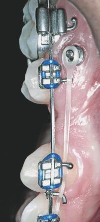 Mini-implantes ortodônticos como auxiliares da fase de retração anterior A B FIGURA 17 - Retração anterior utilizando módulo elástico.