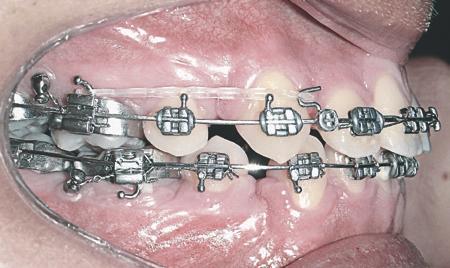 Mini-implantes ortodônticos como auxiliares da fase de retração anterior FIGURA 20 - Ancoragem indireta com mini-implante unido ao tubo da barra transpalatina do primeiro molar por meio de fio de