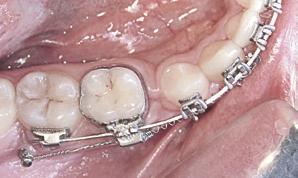Quando se une a barra ao mini-implante por meio de amarril, há pouco controle dos molares e tendência desses se inclinarem para mesial, em resposta à