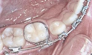 Quando a barra transpalatina é colada com resina composta na cabeça do mini-implante, há um controle melhor da posição dos molares, no entanto, a