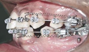 Podese utilizar um fio de amarril para estabilização dos primeiros molares, utilizando o mini-implante como ancoragem indireta (Fig. 23).