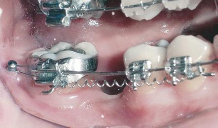 Mini-implantes ortodônticos como auxiliares da fase de retração anterior 3) Distal do segundo molar (Fig. 25) ou região retromolar (Fig. 26), para uso de ancoragem indireta.