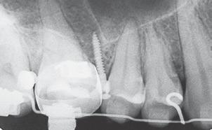 Outra opção de sítio de instalação dos mini-implantes para retração total pode ser a região de tuberosidade na maxila e região retromolar na mandíbula 5,6,9,19,20.