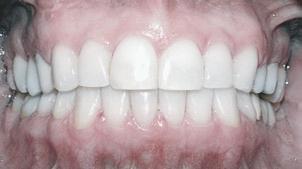Quantidade de retração dos dentes anteriores O uso de