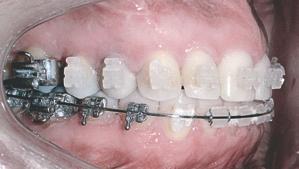 seqüelas de doença periodontal; 4) plano oclusal