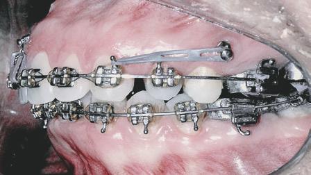 O controle vertical dos incisivos pode, ainda, ser obtido com dobras incorporadas ao arco ou com a instalação de mini-implante na região anterior, para intrusão dos incisivos, durante a fase de