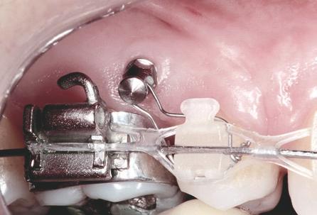 Mini-implantes ortodônticos como auxiliares da fase de retração anterior FIGURA 9 - Posicionamentos verticais diferentes dos mini-implantes podem gerar desníveis do plano oclusal no segmento anterior.