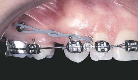 Mini-implantes ortodônticos como auxiliares da fase de retração anterior A B FIGURA 14 - A) Retração com gancho curto e vetor de força intrusivo para os incisivos.