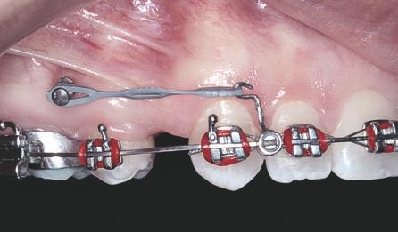 O mesmo tende a ocorrer com os dentes durante a fase de retração, pois a linha de ação de força usualmente passa mais oclusal do que o CR dos dentes anteriores, causando um efeito colateral de