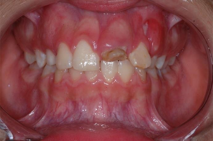 7 O presente trabalho tem por objetivo apresentar um caso clinico de reconstrução coronária com resina composta direta associada a pino intracanal em um dente permanente jovem que sofreu trauma.