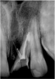 , 2008; D'ARCANGELO et al., 2008). A terapia endodôntica foi realizada pela técnica coroa-ápice (figura 4) e obturação dos condutos radiculares pela técnica da condensação lateral.