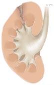 Traumatologia renal nos HUC Experiência de treze anos 47 Figura II: Lesões major (lacerações profundas e extremidade proximal do uretér num caso de avulsão