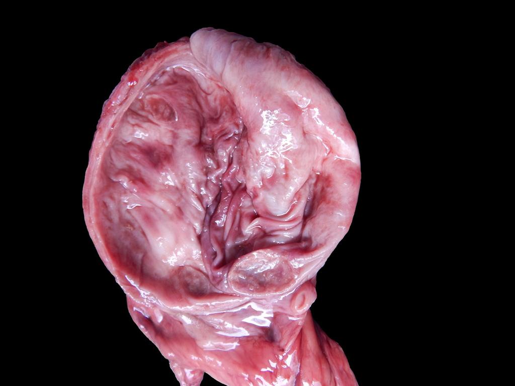 Dioctofimatose renal bilateral e disseminada em cão Fig.2. Rim direito de cão parasitado por Dioctophyme renale. Notam-se placas multifocais esbranquiçadas, irregulares e de consistência dura. Fig.3.