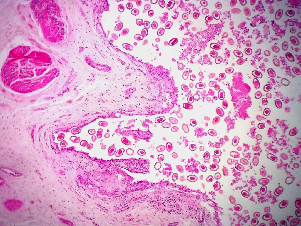 No tórax identificou-se livre na cavidade e formando impressão sob a gordura pericárdica, um parasita macho de D. renale, medindo 20cm (Fig.3).