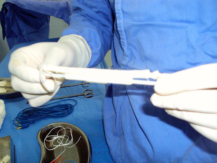 Bruno Morisson, Antonio Luiz de Araújo et al. Figura 1. Prótese antes do implante. Figura 2. Prótese implantada. mais distal da veia axilar.